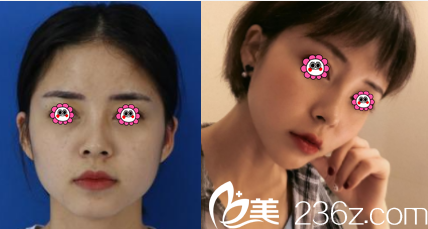 云南华美美莱面部自体脂肪填充案例