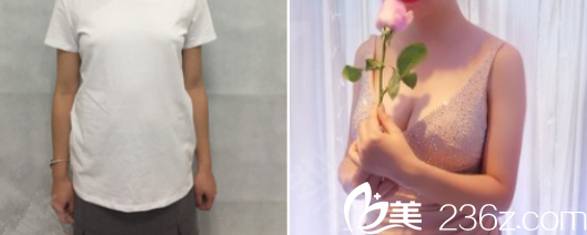 云南华美美莱自体脂肪丰胸案例