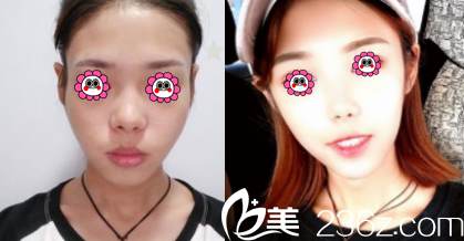 昆明吴氏嘉美面部脂肪填充案例