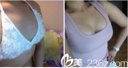 昆明吴氏嘉美自体脂肪丰胸案例