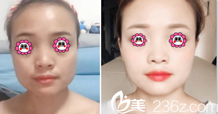 昆明德尔美客自体脂肪面部填充案例