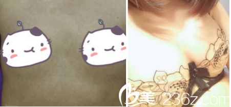 昆明德尔美客自体脂肪丰胸案例