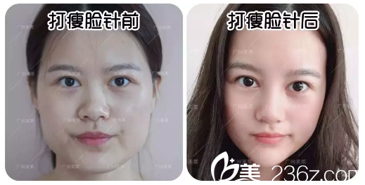 广州美莱瘦脸案例对比图
