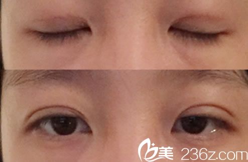 做完双眼皮手术7天恢复照片