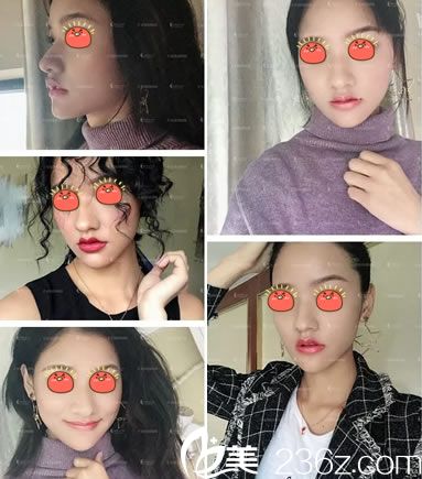 杭州诠昕陈晓晓玻尿酸丰下巴<span style=