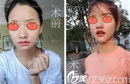 杭州诠昕玻尿酸丰下巴<span style=