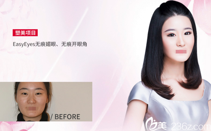 双眼皮+开眼角案例 双眼皮+开眼角案例