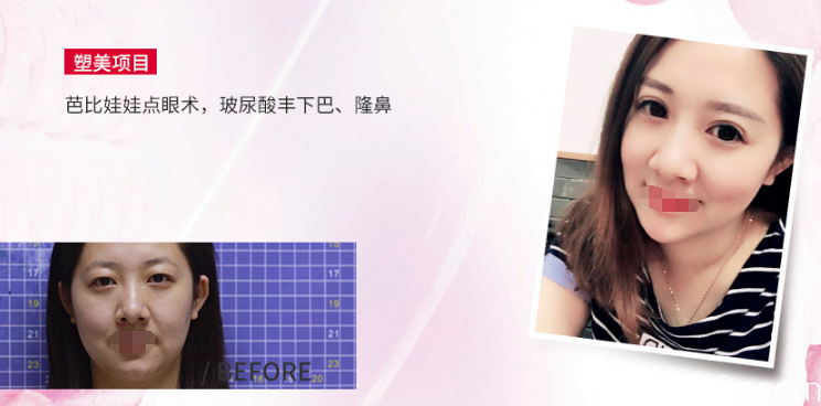 隆鼻+丰下巴+双眼皮案例 隆鼻+丰下巴+双眼皮案例