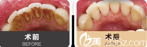 绵阳朗睿牙齿美白案例对比 绵阳朗睿牙齿美白案例对比