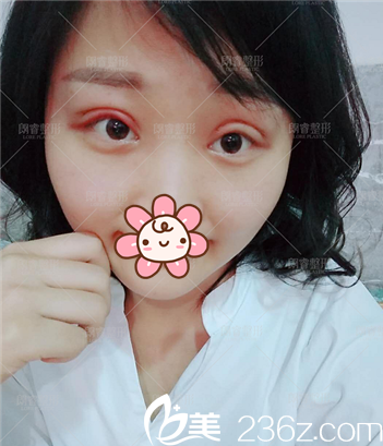 切开双眼皮术后天眼睛肿胀