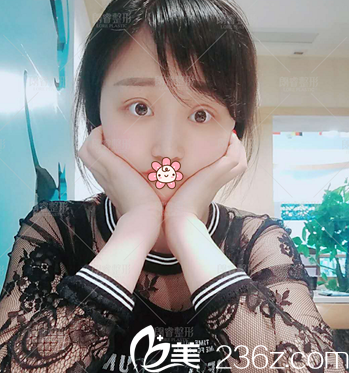 切开双眼皮术后7天照片