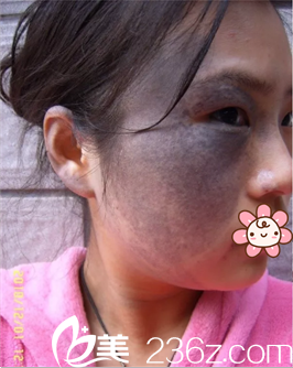 太田痣治疗前照片