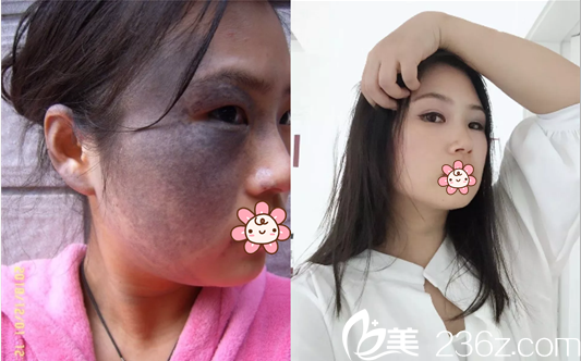 绵阳朗睿王步礼激光祛痣后效果对比