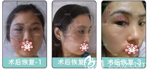 激光去除太田痣治疗过程