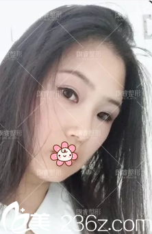 激光去除太田痣治疗效果