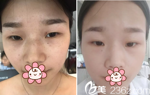 绵阳朗睿激光祛雀斑案例对比