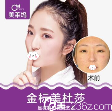 淮北东方美莱坞双眼皮+开眼角综合整形案例