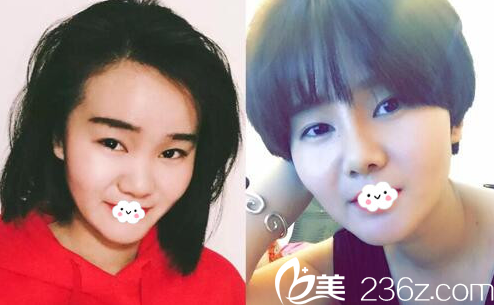 淮北东方美莱坞鼻综合隆鼻真人案例