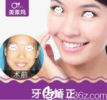 淮北东方美莱坞牙齿矫正真人案例