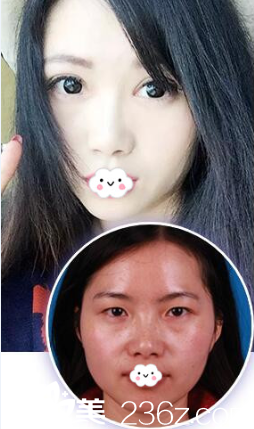 淮北时光双眼皮+开眼角真人案例效果图