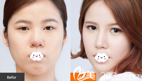 淮北时光假体隆鼻失败修复真人案例