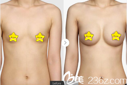 淮北时光假体隆胸真人案例效果对比图