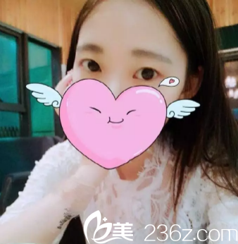 在宝鸡韩美做双眼皮的术前照片 在宝鸡韩美做双眼皮的术前照片