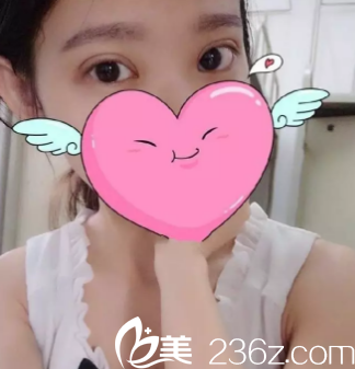 术后15天的样子 术后15天的样子