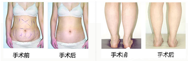 无锡坤如玛丽吸脂案例