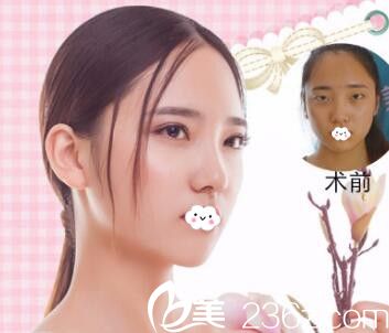 阜阳东方美莱坞勇中华双眼皮真人案例效果图 阜阳东方美莱坞勇中华双眼皮真人案例效果图