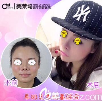 阜阳东方美莱坞鼻综合隆鼻整形真人案例 阜阳东方美莱坞鼻综合隆鼻整形真人案例
