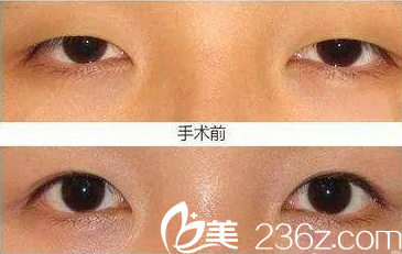 <!--<i data=20240703-sp></li>
<li><i data=20240703-sp></i>-->割双眼皮真人案例效果图