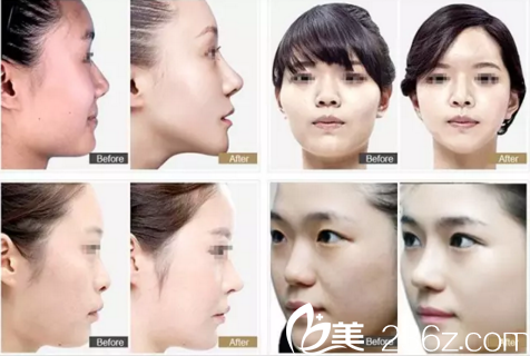 佳木斯隆鼻真人案例 佳木斯隆鼻真人案例