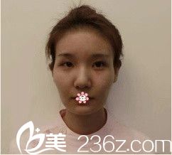 术前我看着显老 术前我看着显老