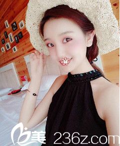 <!--<i data=20240703-sp></i>-->美莱自体脂肪全脸填充术后半个月 <!--<i data=20240703-sp></i>-->美莱自体脂肪全脸填充术后半个月