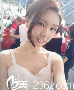 <!--<i data=20240703-sp></i>-->美莱杨继红自体脂肪填充术后一个月 <!--<i data=20240703-sp></i>-->美莱杨继红自体脂肪填充术后一个月