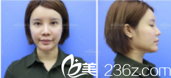 欣茜术前照 欣茜术前照