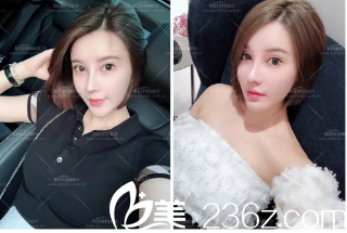 去年花了4000大洋在淄博美冠臣美容医院做了鼻综合手术，从拆线后到现在总是忍不住拍照片