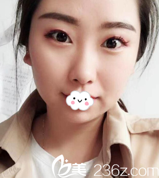 <i data-id='0fc1f97a-7e81-4446-b20d-c7f56a37e144' style='display:none;'></i>医疗美容科王埴铖双眼皮真人案例 <i data-id='0fc1f97a-7e81-4446-b20d-c7f56a37e144' style='display:none;'></i>医疗美容科王埴铖双眼皮真人案例