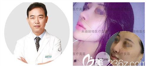 北京米扬丽格巫文云隆鼻案例