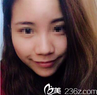 综合隆鼻术前照片 综合隆鼻术前照片