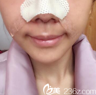 鼻综合术后第2天照片 鼻综合术后第2天照片