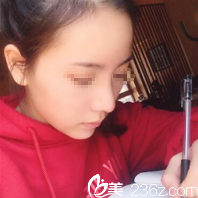 四川广元医尔美美华综合隆鼻术后效果 四川广元医尔美美华综合隆鼻术后效果