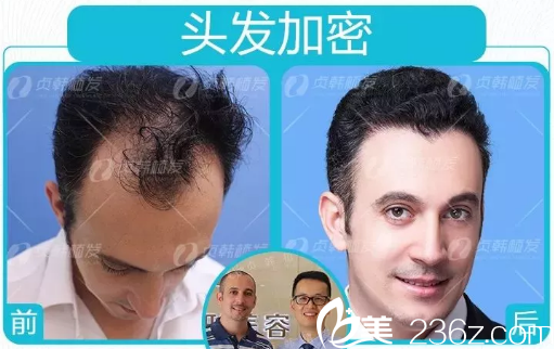 广西南宁贞韩医院做头发加密种植效果图