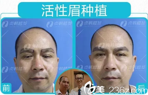 江先生在南宁贞韩植发医院做开运眉毛种植的对比图