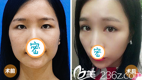 广元医而美美华整形外科双眼皮案例效果