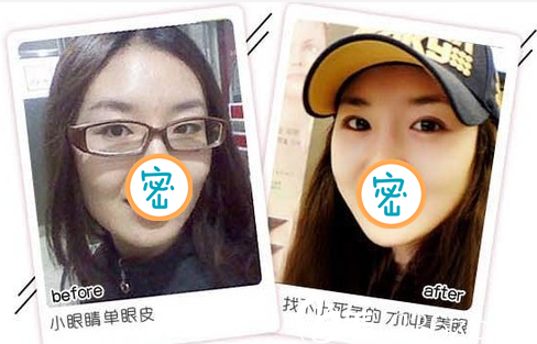 广元美华双眼皮案例对比照片