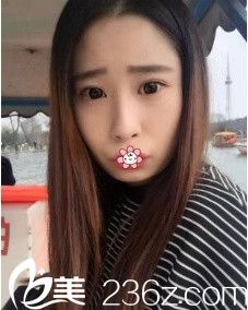 术前我的下巴很短 术前我的下巴很短