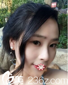 贵州利美康刘德东假体垫下巴术后一个月 贵州利美康刘德东假体垫下巴术后一个月