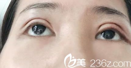 做完双眼皮手术的照片